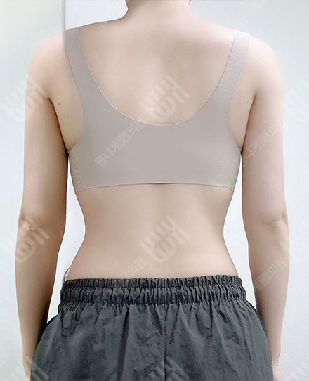 BackLiposuction2 후