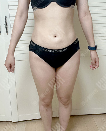 Pelvis Fat grafting 3 전
