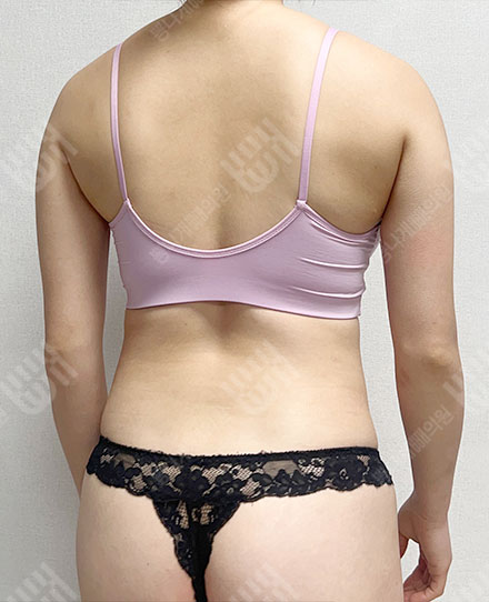 BackLiposuction6 전