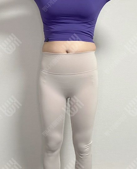 Pelvis Fat grafting7 전