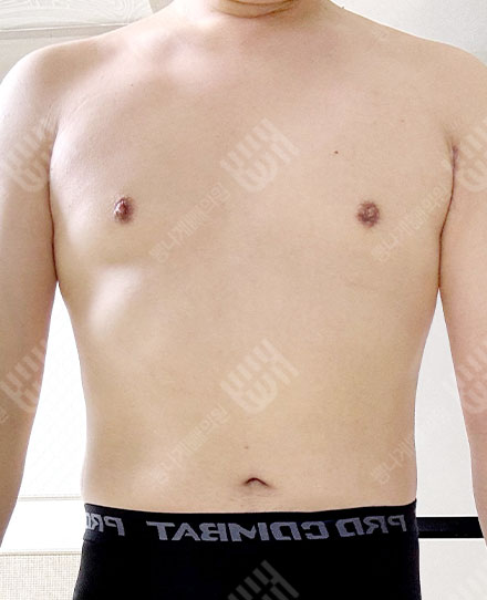 Gynecomastia4 후