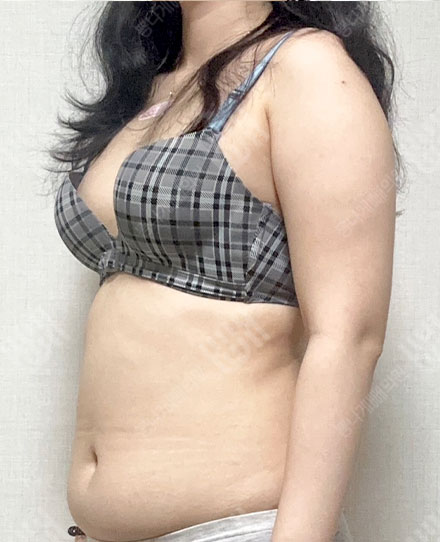 ForearmLiposuction5 전