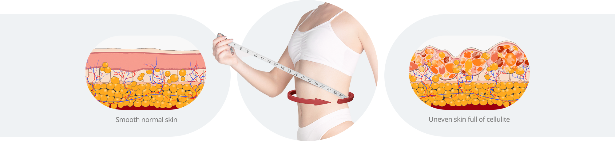Comparison Between Normal Skin and Cellulite-Affected Skin