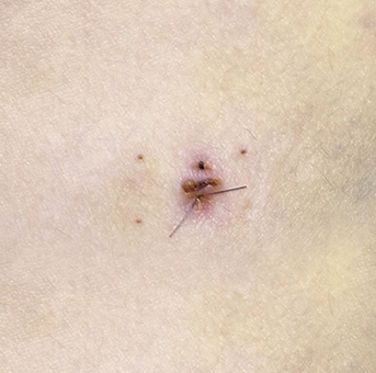 Clear scar liposuction before surgery