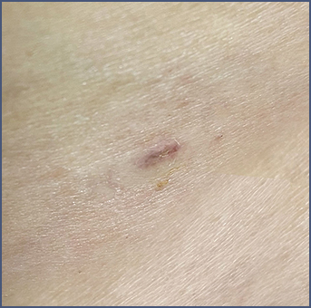 Clear scar after liposuction surgery
