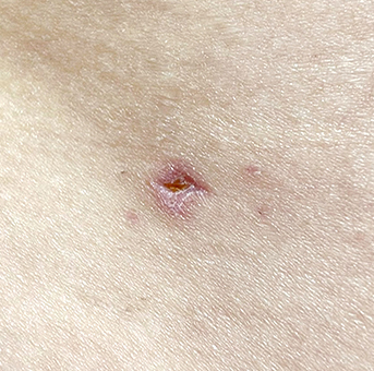 Clear scar liposuction before surgery