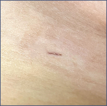 Clear scar after liposuction surgery