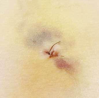 Clear scar liposuction before surgery