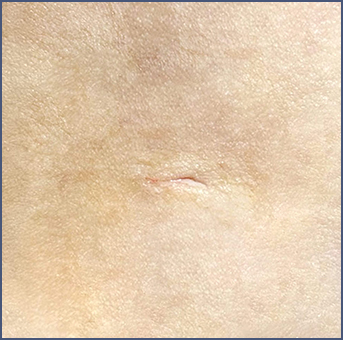 Clear scar after liposuction surgery