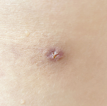 Clear scar liposuction before surgery