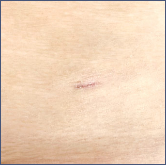Clear scar after liposuction surgery
