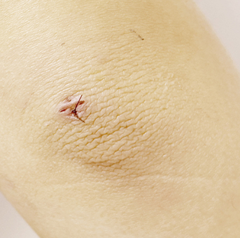 Clear scar liposuction before surgery