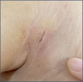 Clear scar after liposuction surgery