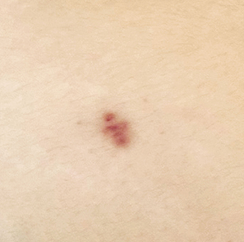 Clear scar liposuction before surgery