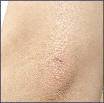 Clear scar after liposuction surgery