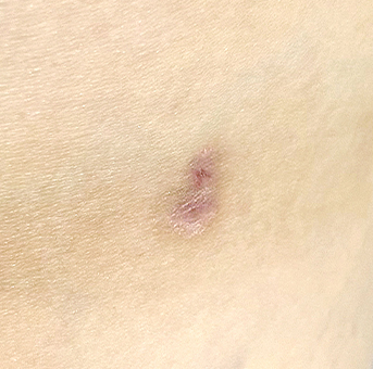 Clear scar liposuction before surgery