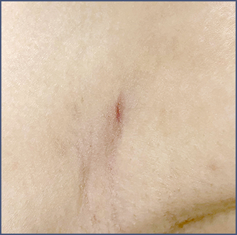 Clear scar after liposuction surgery