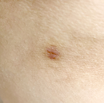 Clear scar liposuction before surgery