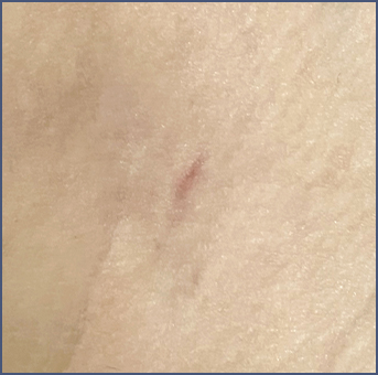 Clear scar after liposuction surgery