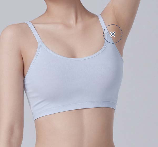 Clear scar liposuction before and after photos

