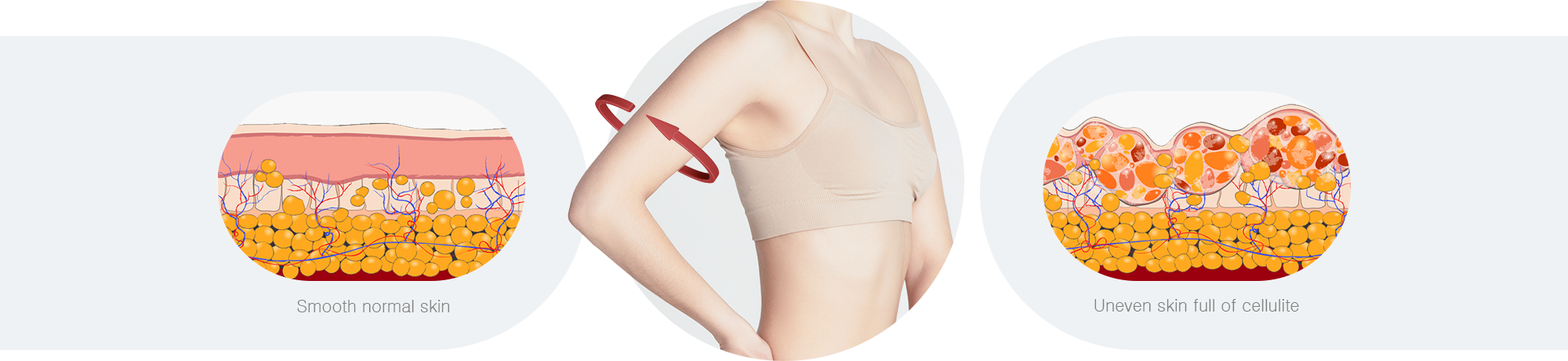 Comparison Between Normal Skin and Cellulite-Affected Skin