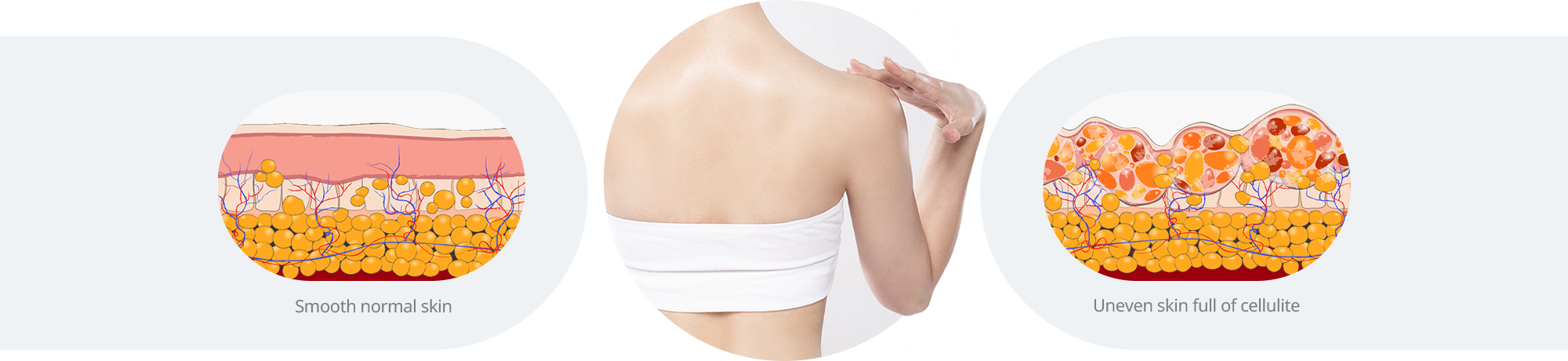 Comparison Between Normal Skin and Cellulite-Affected Skin