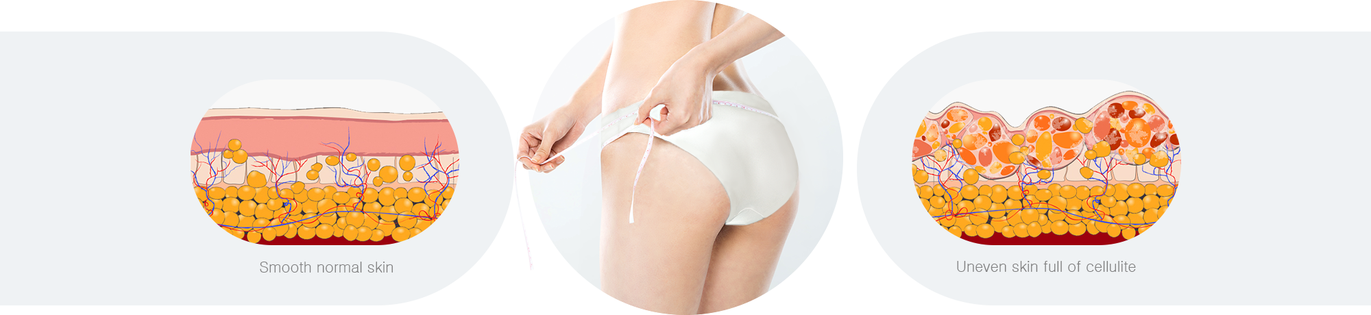Comparison Between Normal Skin and Cellulite-Affected Skin