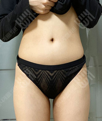 Before: Before surgery