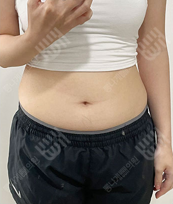 Before: Before surgery