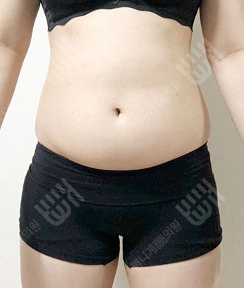 Before: Before surgery