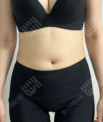Before: Before surgery