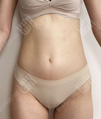 Before: Before surgery