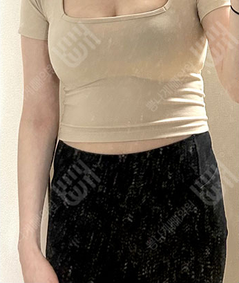 Before: Before surgery