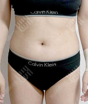 Before: Before surgery