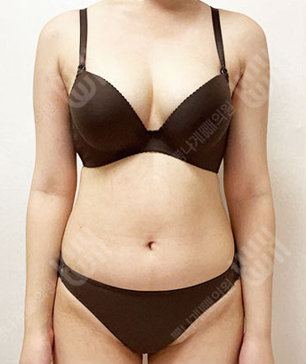 Before: Before surgery