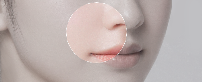 visible nasolabial folds