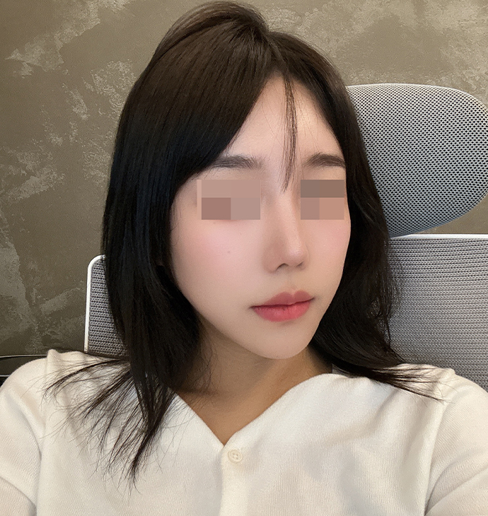 Bbae Clinic Face
Fat grafting