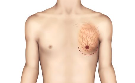 Fibroglandular Gynecomastia