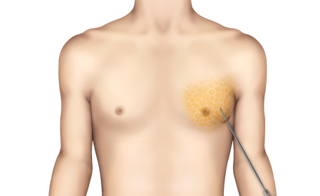 Pseudo Gynecomastia