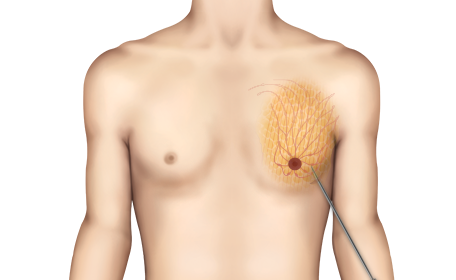 Complex Gynecomastia