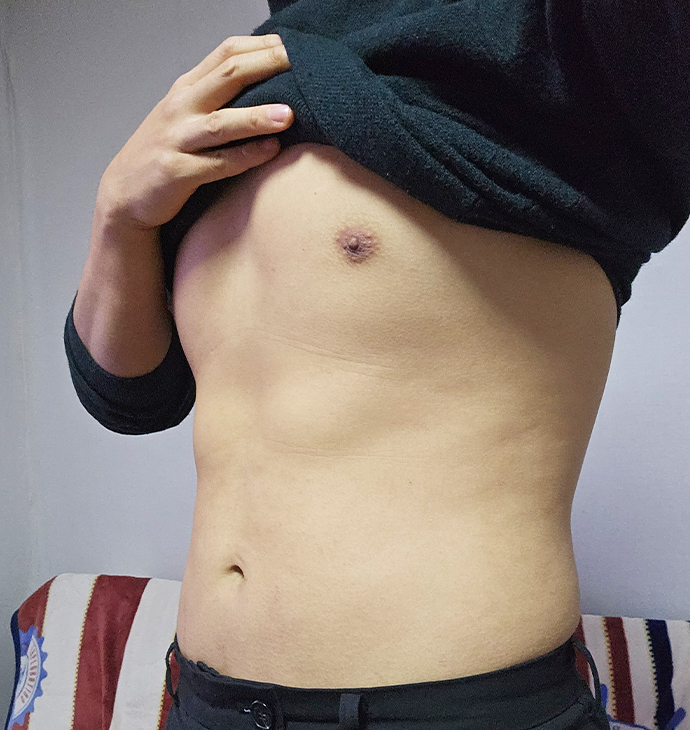 Bbae Clinic Male Gynecomastia
