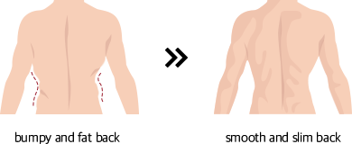 bumpy and fat back >> smooth and slim back