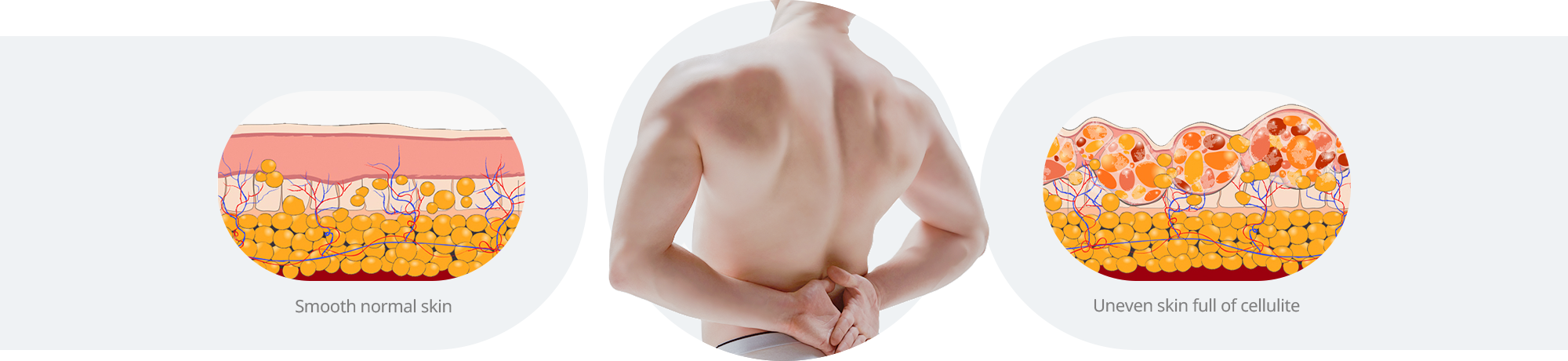 Comparison Between Normal Skin and Cellulite-Affected Skin
