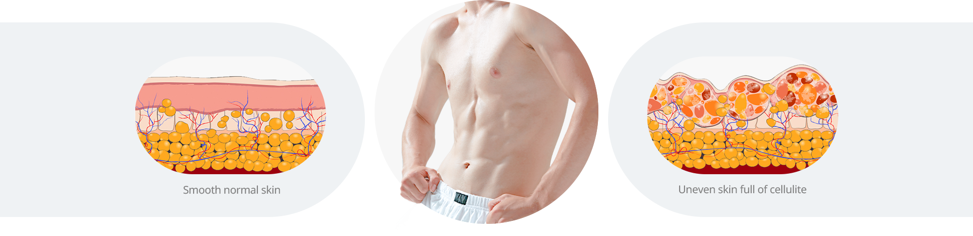 Comparison Between Normal Skin and Cellulite-Affected Skin