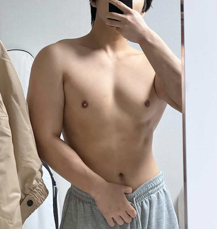 Bbae Clinic Abdomen
Liposuction
