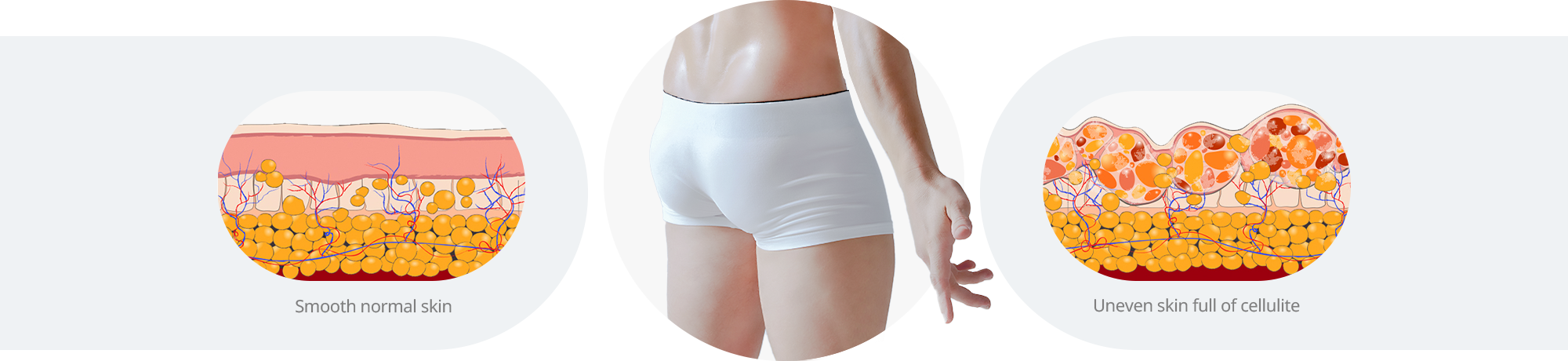 Comparison Between Normal Skin and Cellulite-Affected Skin